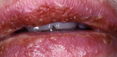 <p>Acute, self-limited mucocutaneous disease.</p>