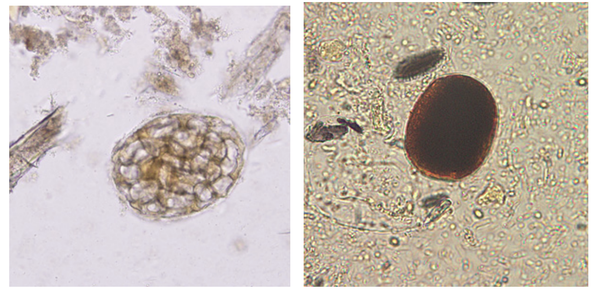 <p>plant fibers in stool that may resemble</p>