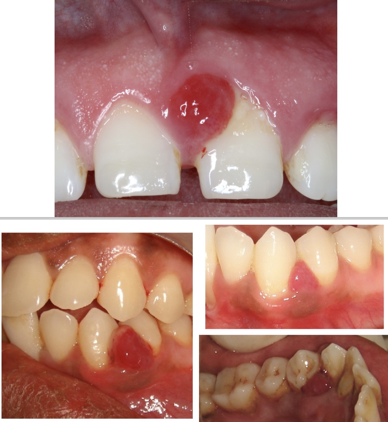 <p>Exophytic growth of pedunculated base</p><p>Painful </p><p>Located mainly in the anterior sector of maxilla</p><p>Due to exaggerated response to irritants (e.g calculus)</p><p>Rapid growth</p><p>Easy bleeding</p>