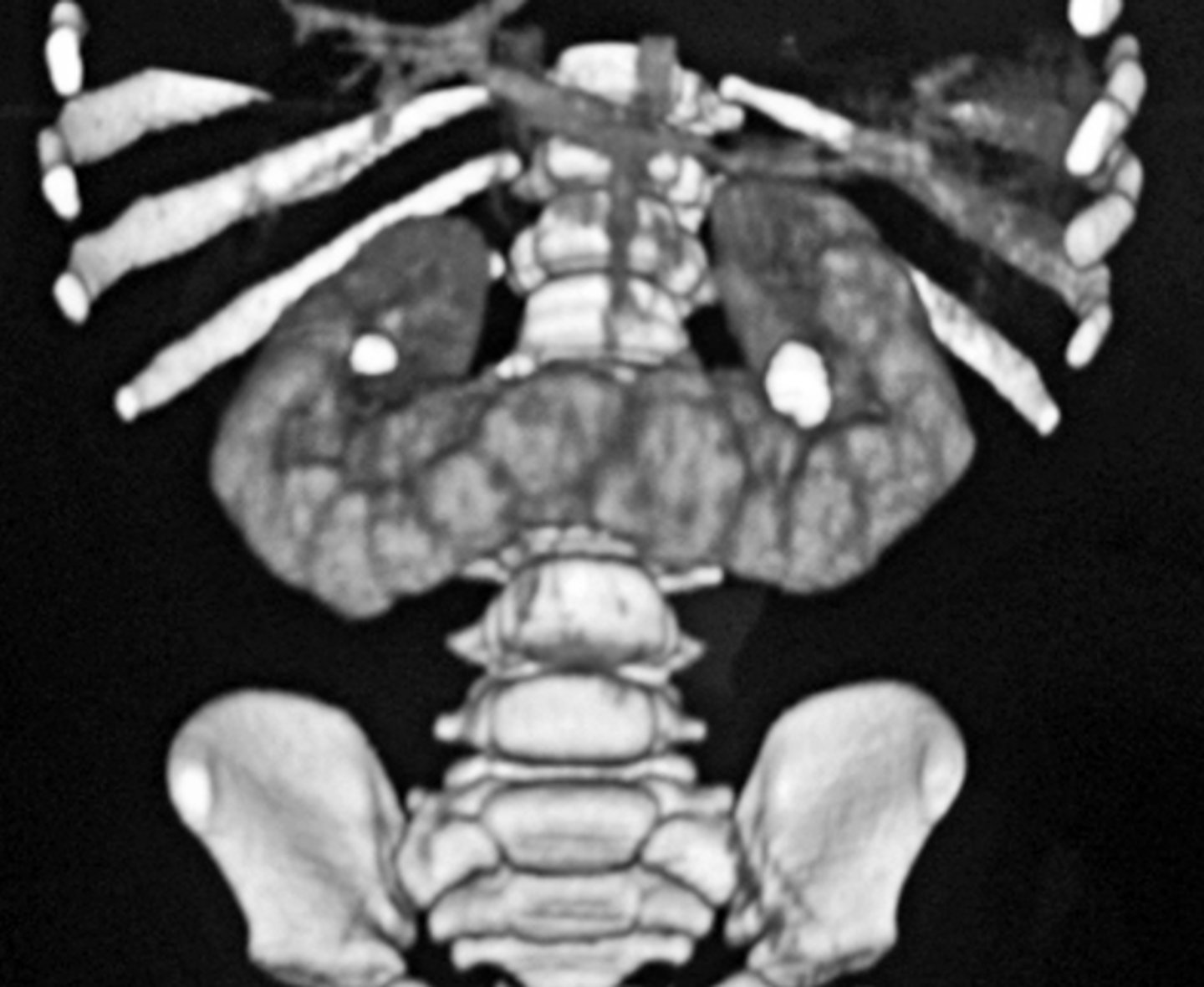 <p>Fusion of the lower poles of the kidneys, Low position of the renal units, and Malrotation</p>