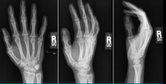 <p>All radiographic procedures of the skeletal system involving joints require a minimum of 3 projections (AP/PA, Lateral, & Oblique)</p><p>Reasoning: there are multiple surfaces and angles of the bones making up the joint, and a small oblique chip fracture or other abnormality within the joint space may not be visual on the AP/PA & lateral views, but may be seen on the oblique view</p>