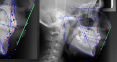 <p>what soft tissue measurement:</p><p>- Upper lip to E-Plane</p><p>- Distance from the most protrusive point on the upper lip to E-Plane along a perpendicular line</p><p>- If U Lip is anterior to E-Plane, the measurement is positive</p><p>- If U Lip is posterior to E-Plane, the measurement is negative</p><p>- Tells you about upper lip protrusion</p>