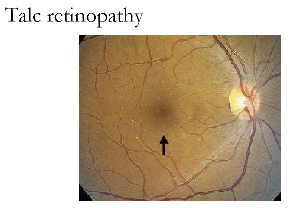 <ul><li><p>Cholesterol (holenhjorst plaque) : shiny yellow to orange</p></li><li><p>Calcium: gray-white (long-standing)</p></li><li><p>Platelets: dull white, long plugs</p></li><li><p>Talc (retinopathy): shiny, red-yellow, usually in intravenous drug users</p></li></ul><p></p>