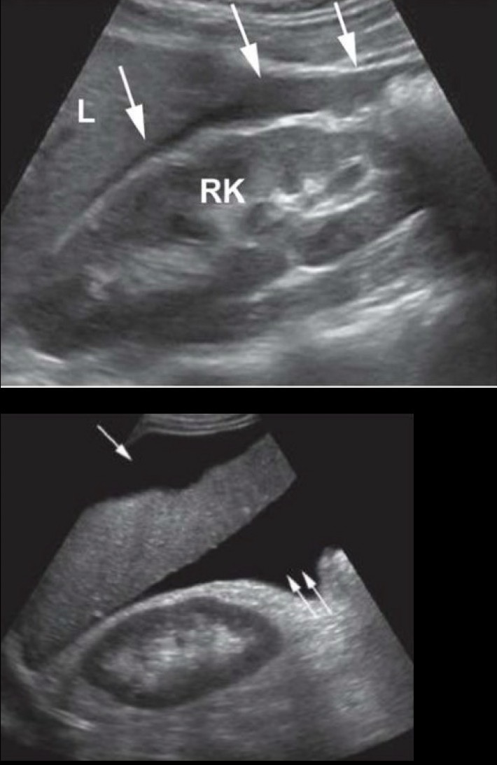 <p>This space is created by the peritoneum reflecting from the liver over the right kidney and right posterior peritoneal wall.</p><p>When a patient is in supine position, this becomes most gravity dependent potential space in abdominal cavity collecting fluid from supracolic area and lesser sac</p><p>2nd image Sagittal shows fluid in hepatorenal space indicated by double arrow (note the sharp fluid filled corners created at organ interface and how organs project into the fluid that fills the space)</p>