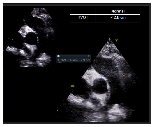 <p><br>*RVOT</p><p></p><p><strong>timing</strong></p><p>- mid-systole: PV open</p><p></p><p>- RVOT: should be taken 5-10mm proximal to annulus</p>