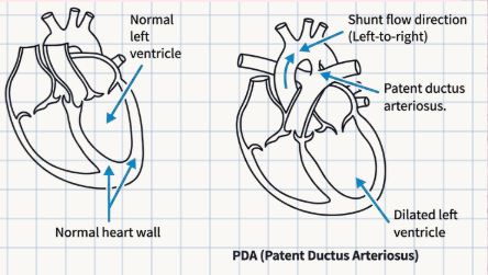 <p>Caused by the <strong>failure of the ductus arteriosus to close at birth</strong>.</p>