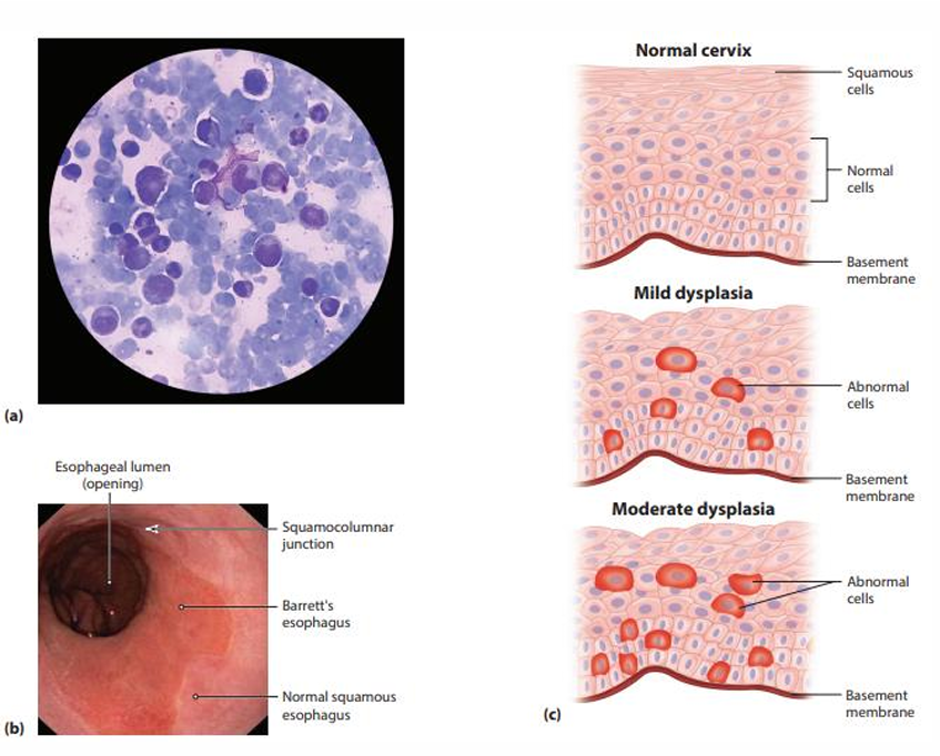 <p>occurs when disease or injury results in <span><strong>displacement of one cell type by anothe</strong></span>r that may be less mature</p><p><em>examples: </em></p><p><span><strong><em>Environmental toxins</em></strong><em> (e.g., air pollution) --> respiratory epithelial cells</em></span></p><p><span><strong><em>Chronic inflammation</em></strong><em> - Barrett's esophagus from chronic gastric reflux</em></span></p><p><span><strong><em>Vitamin A deficiency:</em></strong><em> urinary and respiratory epithelial cells</em></span></p>