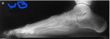 <p><strong>Name what anatomy is demonstrated in this projection of the foot</strong></p>