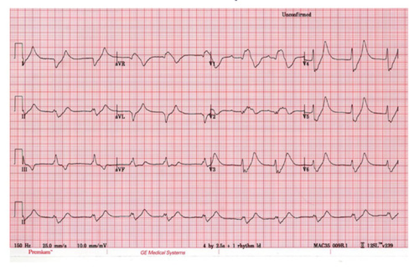 <p>this is an example of _____, characterized by sine wave pattern</p>