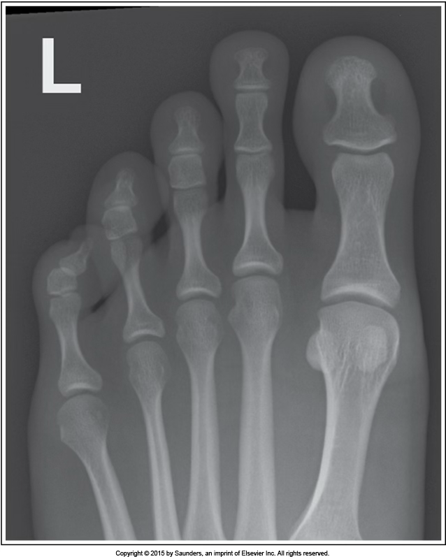 <p>AP axial toe</p>