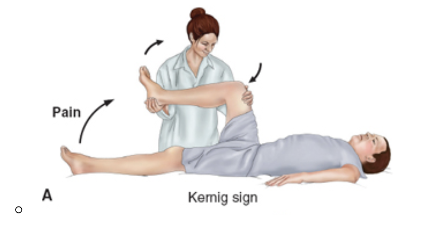 <p>Kernig’s Sign </p>