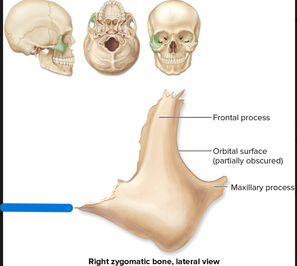 <p>temporal process of zygomatic bone</p>
