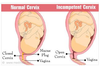 <p>• Passive and painless dilation of the cervix during the second trimester</p><p>• May be either acquired or congenital</p><p><strong>• Diagnosis</strong></p><p>• Measurement of cervical length has been used as a way to diagnose cervical insufficiency</p><p>• Identify women who have cervical changes because of</p><p>impaired cervical strength before conception or in early</p><p>pregnancy rather than when they are beginning the process</p><p>of preterm labor</p><p>• Speculum/digital pelvic exams; transvaginal U/S</p><p>• abnormally short cervix – less than 25 mm</p><p>• Cervical funneling</p><p></p>
