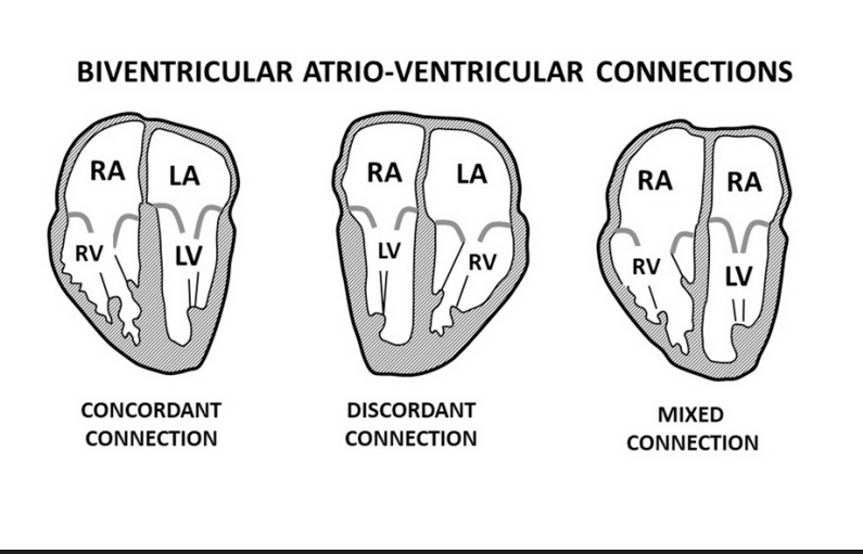 <p>START WITH ATRIA TO VENTRICLE CONNECTION</p>
