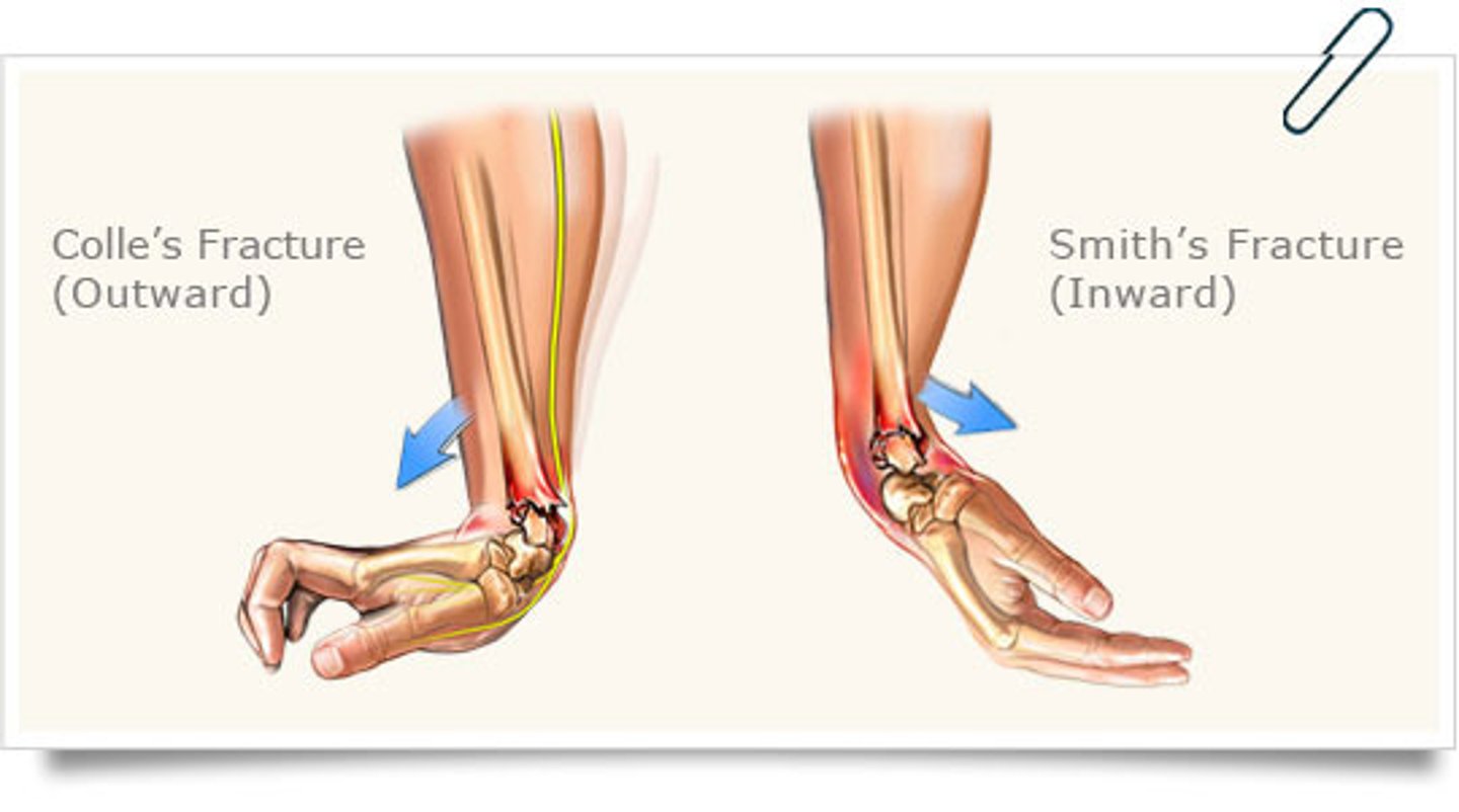 <p>fracture of the distal end of the radius</p>