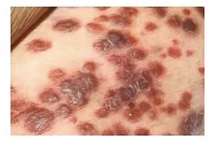 <p>-Bartonella</p><p>-HIV/AIDS; they’re immunocompromised</p><p>-blood vessels</p><p>-numerous red/purple nodules</p><p>-lymphocytes AND neutrophils; only has lymphocytes</p>