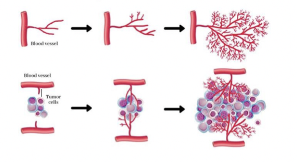 <p>formation of new blood vessels</p><ul><li><p>initial growth of tumour is close to existing blood vessels (1mm)</p></li><li><p>tumour grows → more cells required more nutrients + oxygen supplied by blood</p></li><li><p>success of tumour induced blood vessel formation → dictates if metastasis will remain dormant or grow larger than 1mm</p></li><li><p>cancer cells secrete signalling molecules → stimulate proliferation of endothelial cells → secrete proteases causing capillary sprouts to form = new capillary bed</p></li></ul><ul><li><p>liver + lung = common metastasis sites</p></li><li><p>cancer-induced growth disorganized + not well-structured</p><ul><li><p>leaky + unstable</p><ul><li><p>large tumours can be bleeding </p></li></ul></li><li><p>radiation can cauterize bleeding </p></li></ul></li></ul><p></p>