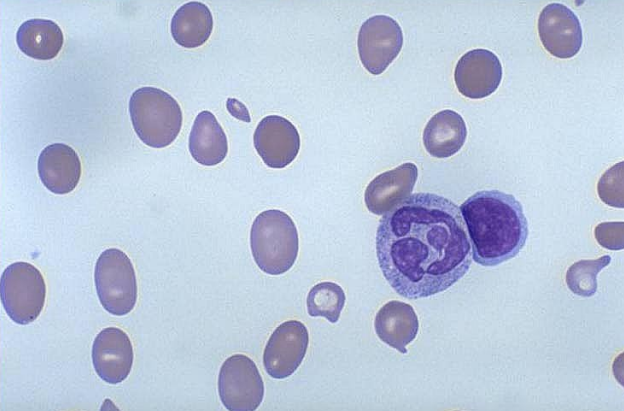 <p>what anemia is this?</p>