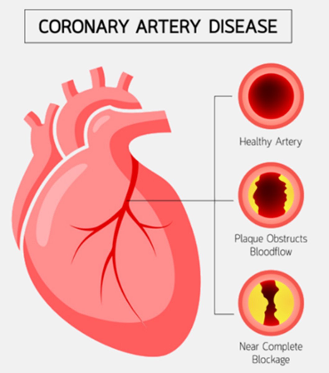 <p>B) Age, Hypertension (HTN), Genetics, Tobacco use, Diabetes, Obesity, Sedentary lifestyle, Hypercholesterolemia, High triglycerides, Metabolic syndrome, Stress, Illicit drug use (cocaine)</p>