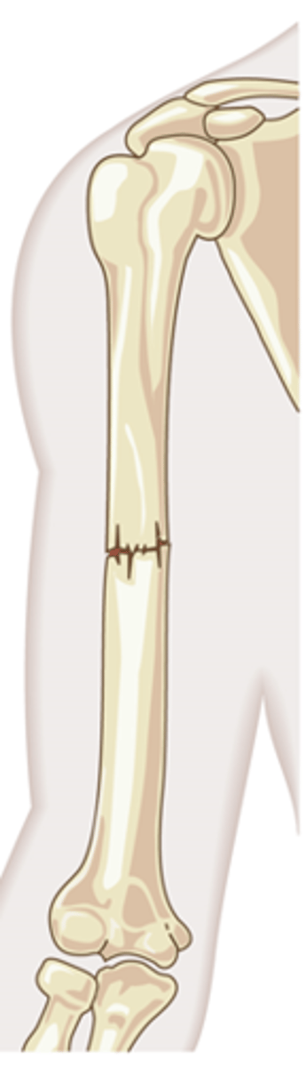 <p>a bone fracture in which the bone does NOT penetrate the skin</p>