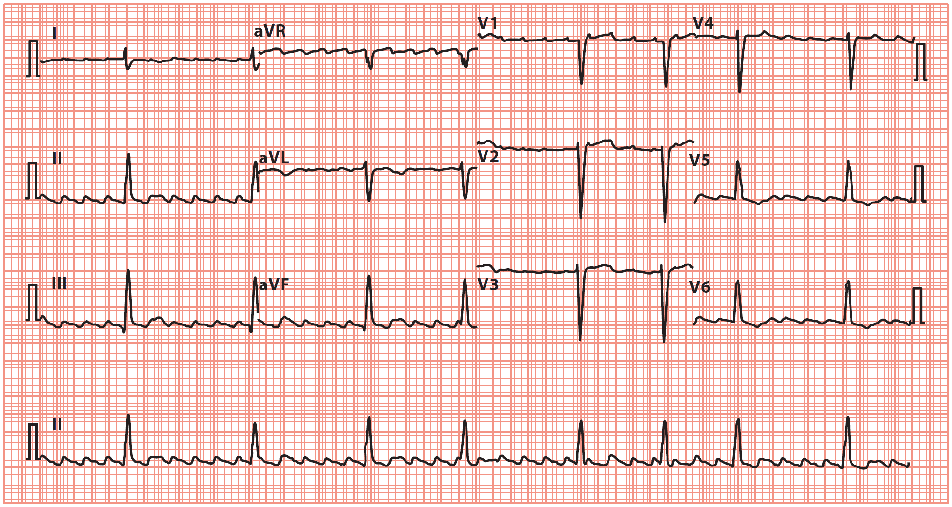 <p>Isthmus dependent, single reentrant circuit around tricuspid annulus (R atrium)</p><p>-Sx: palpitations, fatigue, dyspnea, presyncope, sx of HF </p><p>-EKG: atrial rate ~300 bpm, ventricular ~150bpm. See the waves in a sawtooth pattern </p><p>-Definitive treatment is radiofrequency ablation </p>