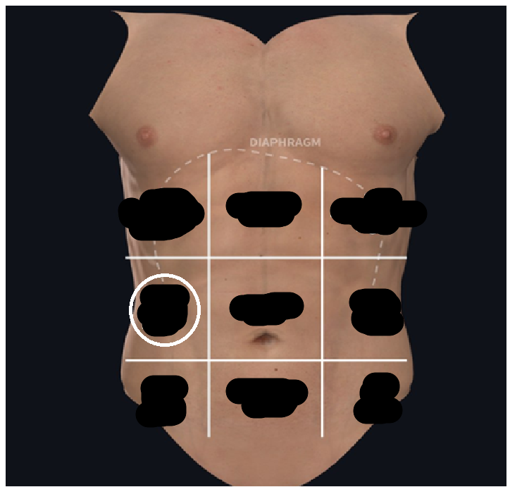 <ul><li><p><span style="background-color: transparent;">Lateral to umbilical region</span></p></li><li><p><span style="background-color: transparent;">At the waist</span></p></li></ul><p></p>