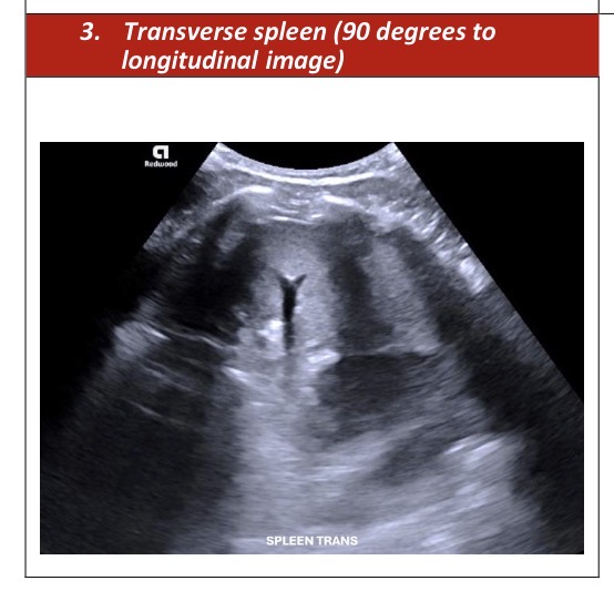 <p>Spleen Transverse Survey</p>