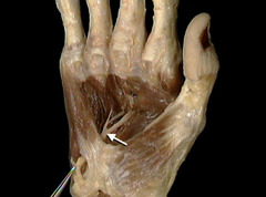 <p>Which of the following muscles receives its motor innervation from the nerve indicated by the arrow?</p>