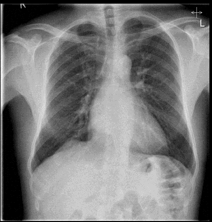 <p><span>Male. 42 years. Persistent cough. Otherwise well</span></p>