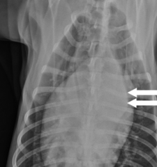 <p>What radiographic sign indicates PDA?</p>