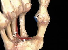 <p>In this anterior view of the skeleton of the right hand, identify the muscle that has its proximal attachment to the area painted in red and its distal attachment to the area painted in blue.</p>