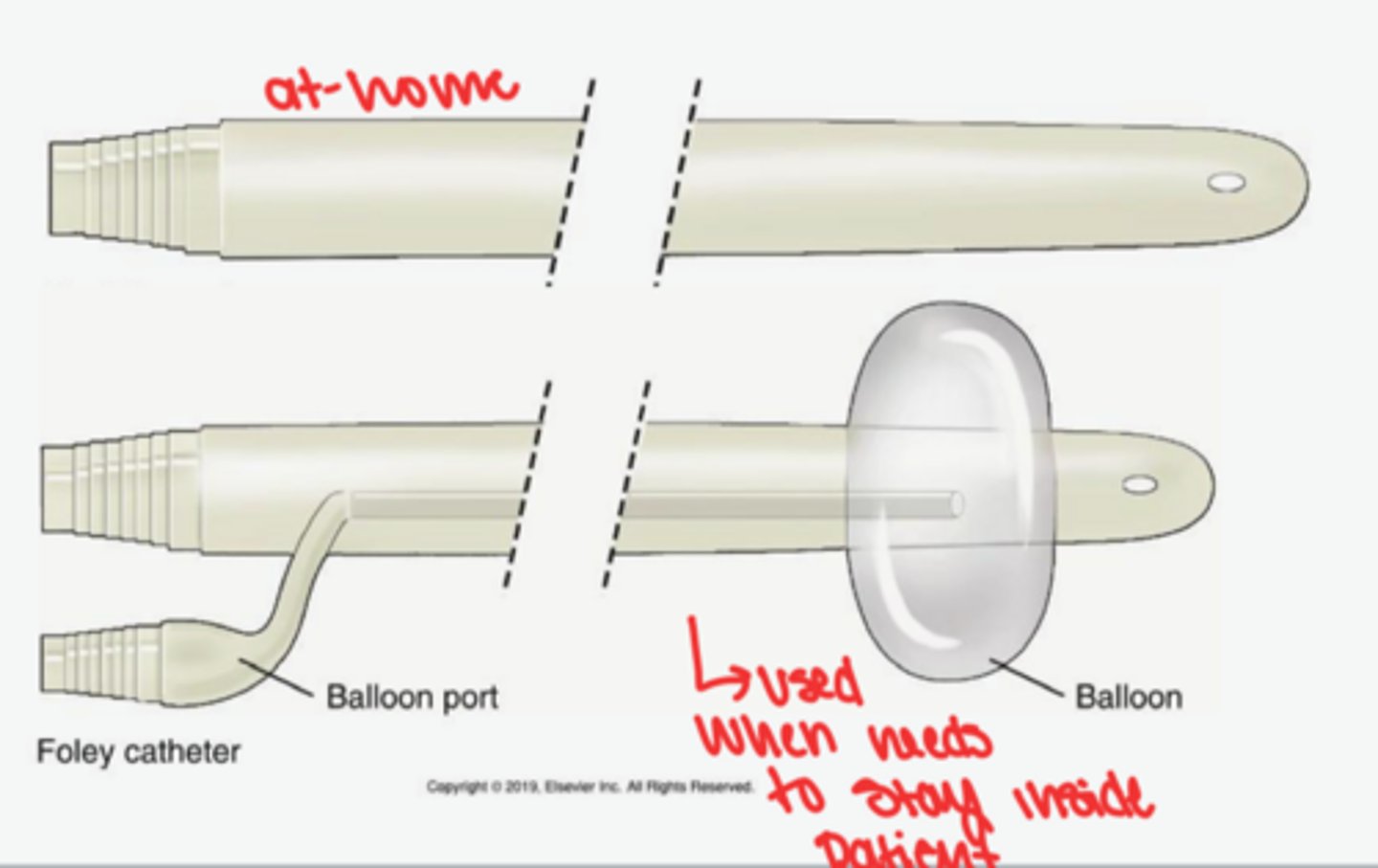 <p>Indwelling (foley)</p><p>Intermittent/in and out/ straight catheterization (Bardex)</p>