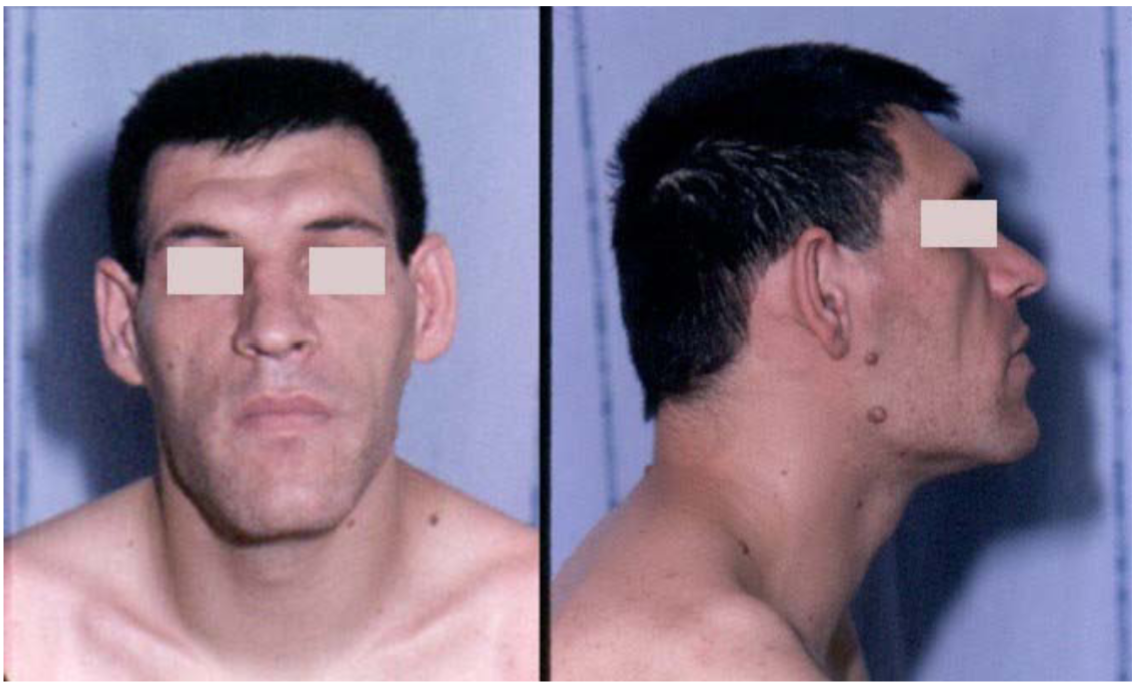 <p>Enlarged <span style="color: rgb(10, 246, 208);"><strong>prognathic mandible (prognathism)</strong></span></p>