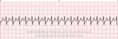 <p>Rapid heart rate originating above ventricles.</p><p>most common: reentry b/t atrium & ventricle in the AV node</p>