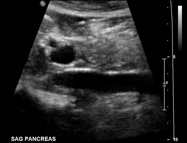 <p>Use your mouse to place your cursor over the main portal vein and click to mark the vessel. </p>