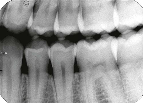<p>Overlapping Contacts </p><p><strong>What it looks like:</strong><br>Teeth appear stacked on top of each other and you can’t see between them.</p><p> </p><p><strong>Cause:</strong><br>Incorrect <strong>horizontal angulation</strong>.</p>