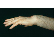 <p>fracture of distal radius with anterior (palmar) displacement</p>