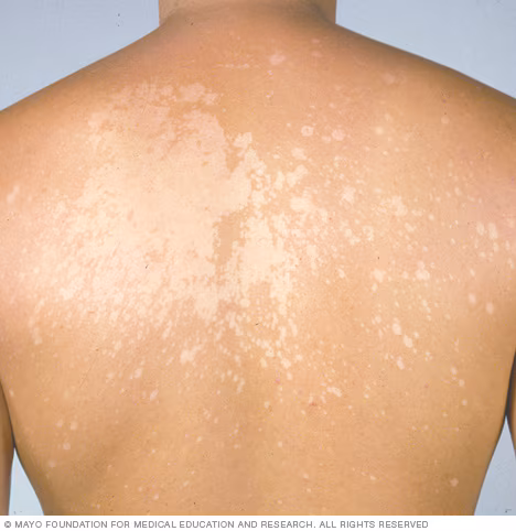 <p>tinea versicolor</p>