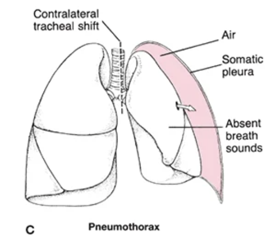 <p>air enters the pleural space, causing partial or complete lung collapse</p><ul><li><p>TENSION pneumothorax is a medical emergency!!!! due to impaired venous return</p></li></ul><p></p>