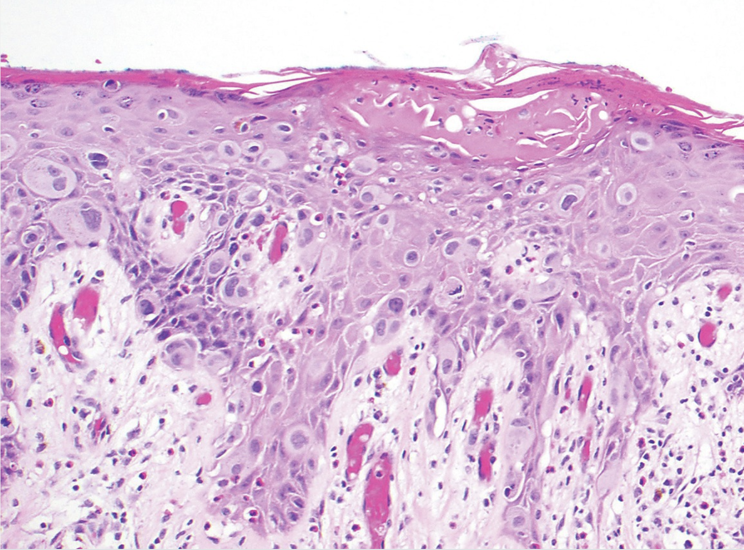 <p>Lésion du mamelon </p><p>1) diagnostic</p><p>2) origine </p><p>3) IHC </p><p>4) DD </p><p>5) formes </p>