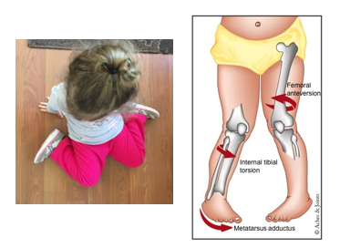<p>Femoral torsion </p>