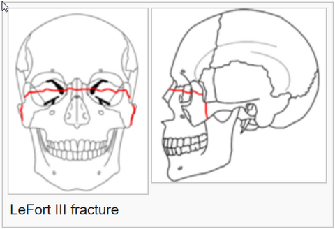<p>caused by side impacts and transverse the upper orbits and nasal bones, separating the maxilla, nasals and zygomatics from the cranial vault</p>
