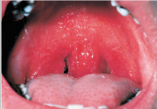 <p><strong>Strep throat </strong>is caused by <strong><em><u>streptococcus pyogenes</u></em></strong></p><ul><li><p>Strep throat is an <strong>upper respiratory infection </strong>that leads to a <strong>sore throat </strong>with <strong>throat</strong> <strong>pain</strong>, <strong>difficulty swallowing</strong>, and <strong>high fever</strong></p></li></ul><p></p>