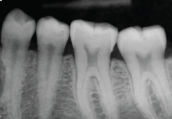 <p>Elongation </p><p><strong>What it looks like:</strong><br>Teeth appear <strong>long and stretched</strong>.</p><p> </p><p><strong>Cause:</strong><br>Insufficient <strong>vertical angulation</strong>.</p>