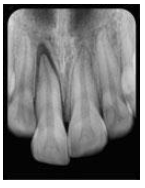 <p>Which trauma:</p><ul><li><p>Tooth appears elongated</p></li><li><p>Excessively mobile</p></li><li><p>Sensibility test -</p></li><li><p>Increased PDL space apically</p></li></ul><p></p>