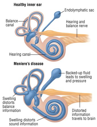 <ul><li><p>Buildup of <strong>endolymph</strong> within the <strong>inner ear</strong></p></li><li><p>Disrupts functioning of <strong>hair cells</strong></p></li><li><p>Unclear cause</p></li></ul><p></p>