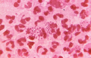 <p>What does seeing gram-negative diplococci suggest?</p>