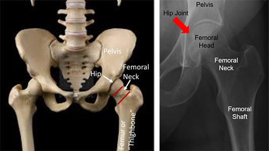 <p>Neck of the femur</p>
