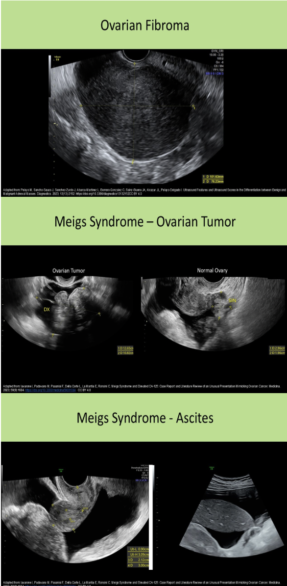 <p>C. fibroma</p><p>Meigs syndrome = pelvic ascites and pleural effusion with benign ovarian tumor (fibroma 80-90%, thecoma, granulosa cell tumor)</p>