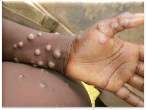 <p>-eradication of small pox allowed Mpox to rise</p><p>-transmitted through indirect and direct contact (sex, touching rash, contact with infected fabrics)</p><p>-SxS(flu-like): fever, chills, swollen lymph nodes, HA, backache, fatigue, myalgia;<strong> lesions all in different stages of healing is hallmark sign(rash appears days 1-4, which is very noticeable and painful, flat spots turn into blisters then scab over)</strong></p><p>-CONTAGIOUS until rash scabs off and heals (2-4 weeks)</p><p>-2 types: Clade 1(central africa, more serious/deadly/spreadable), Clade 2(west africa, not as severe/deadly)</p><p>-people at risk: weaken immune system, <1 y/o, people with eczema, pregnant women</p><p>-VACCINE available for Clade2, not great for Clade 1</p>